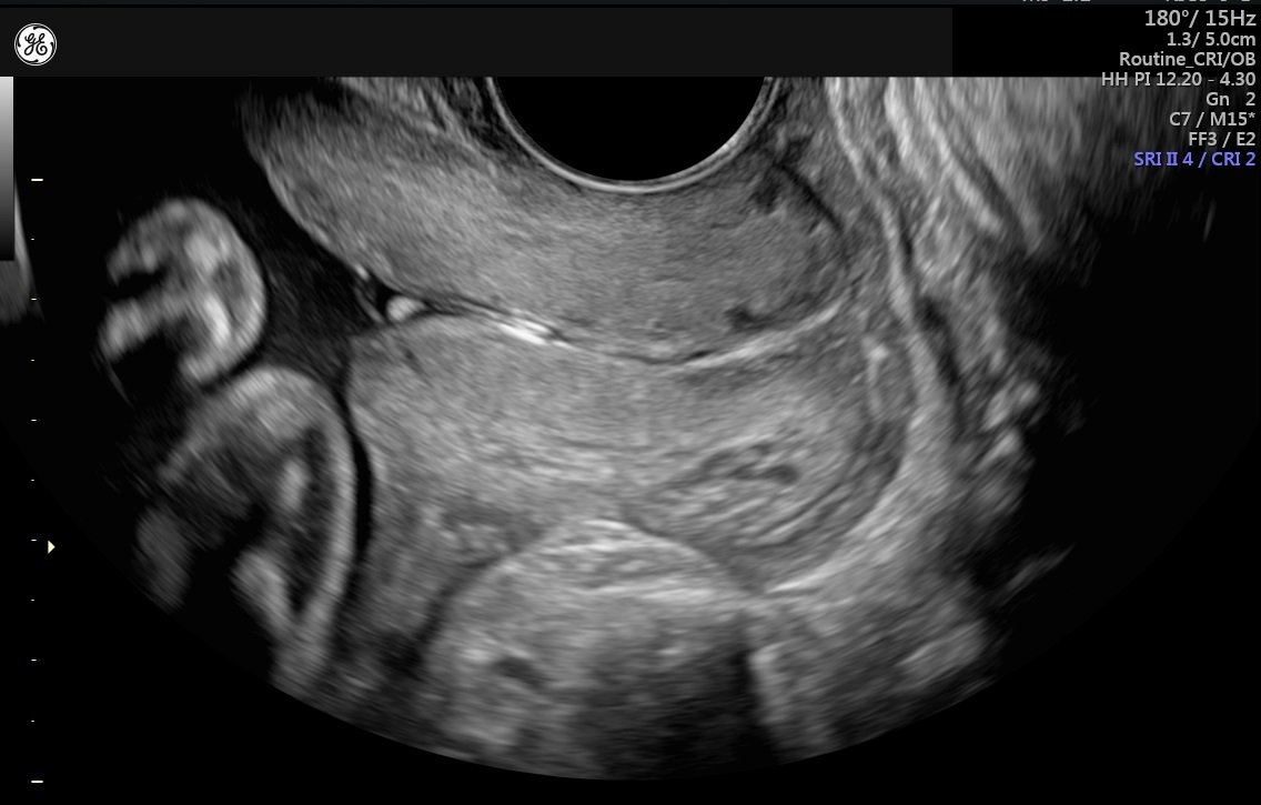 Cervical Length Measurement